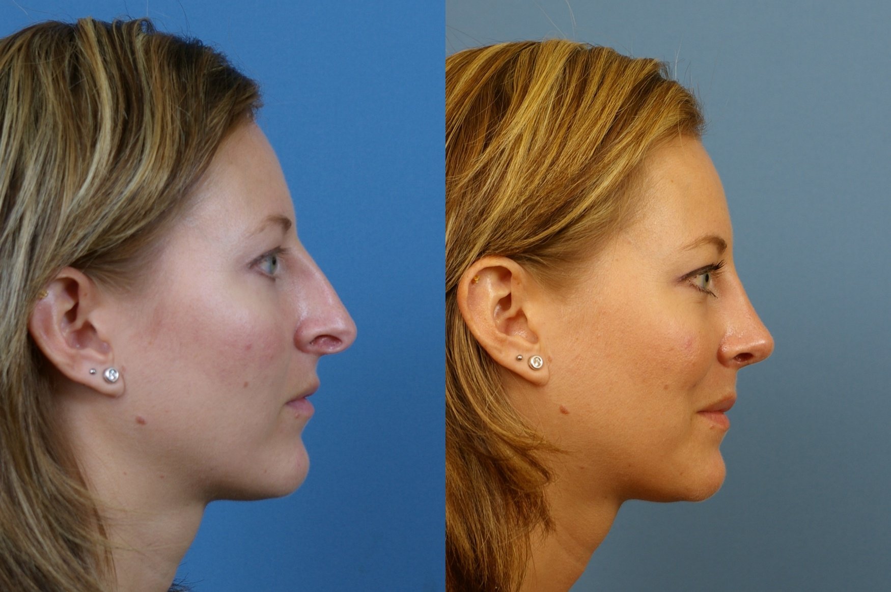 Shotgun Rhinoplasty