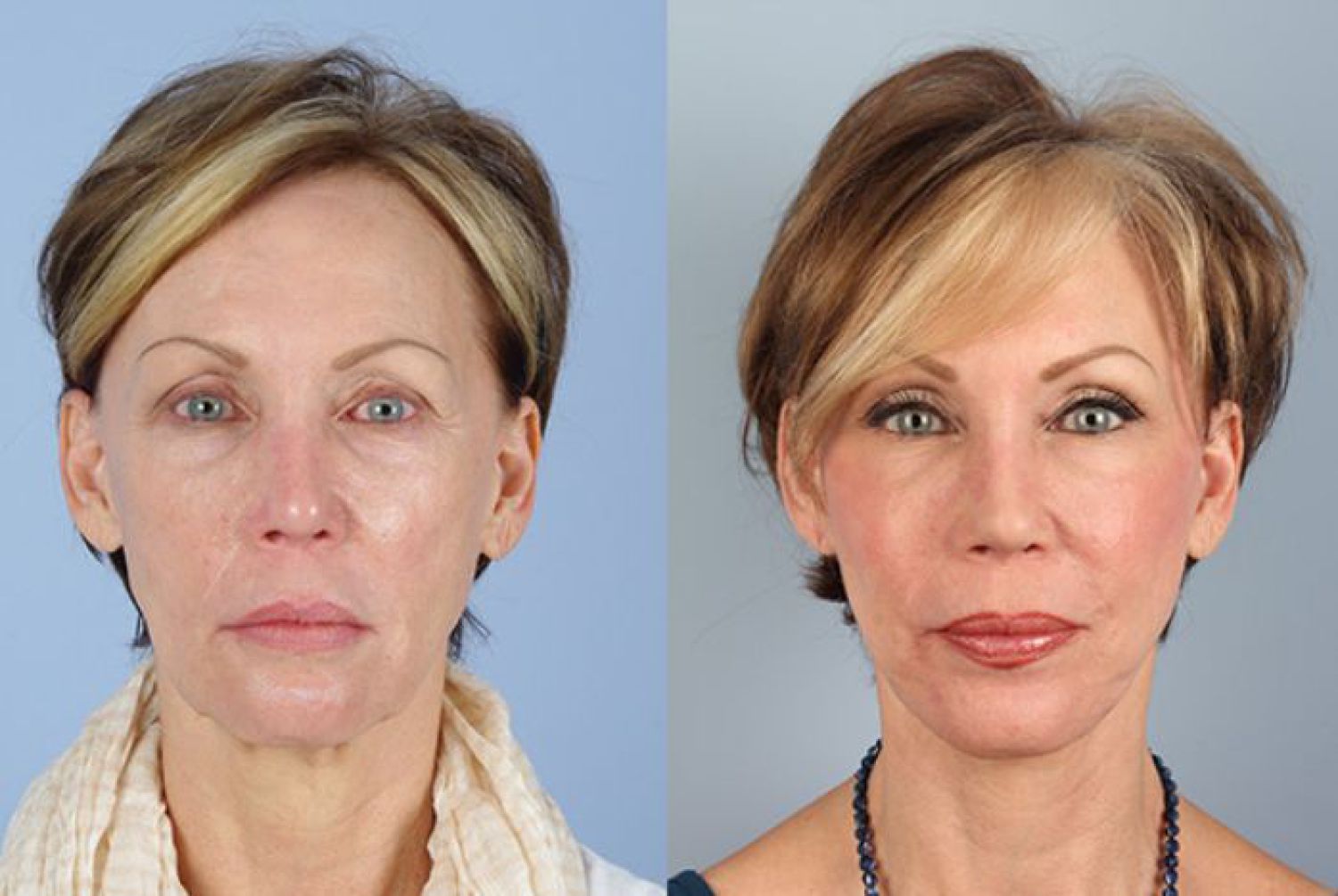 Botox and Fillers Before and Afters, Raval Facial Aesthetics